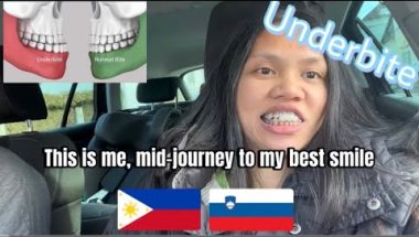 Underbite journey in progress ✨