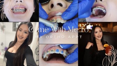 Braces Vlog Ep.14: My 17 Month Braces Update | I got my brackets removed!?