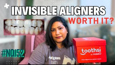 My Toothsi Aligner: Day 1| Unboxing of Toothsi Aligner +  Process Explained | Kis Case Me Best Hain?