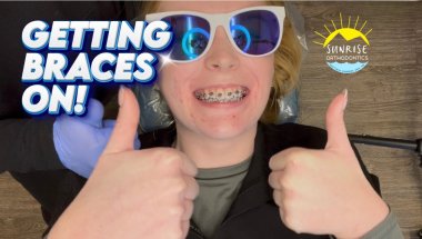 Getting Braces ON: What to Expect (Time-Lapse) | Start to Finish