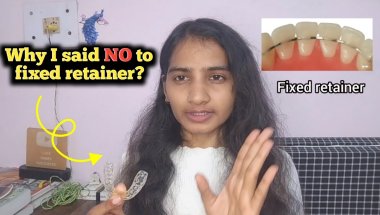 Clear Retainer vs Fixed Retainer – Why I chose clear!
