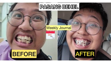 Weekly Journal - December W2 - Pasang Behel Gigi