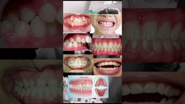 Bracesအကြောင်း General Overview 😬 #Braces #DentalCare  #သွားညှိခြင်း #Ortho #hymovlog