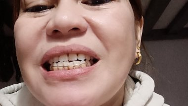 Ang hirap Kumain pag my Retainer teeth 🤣@maryjanecollantesvlog5388 #viralvideo #retainers
