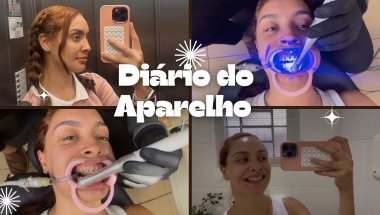 Colocando a parte de baixo do meu aparelho auto ligado 😬 #aparelhoortodôntico #dentista #odontologia