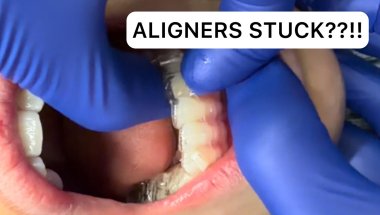 Extreme Aligner Removal 😱 Crowded Teeth + Attachments = This…