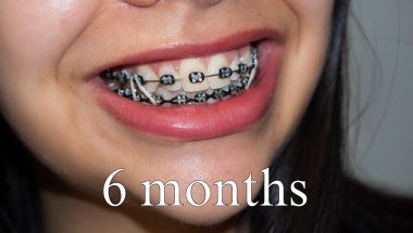 Braces Update: 6 Months In & The Change Is REAL 😳vlog #5
