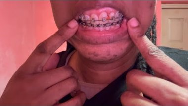 HOW I FLOSS MY TEETH WITH BRACES