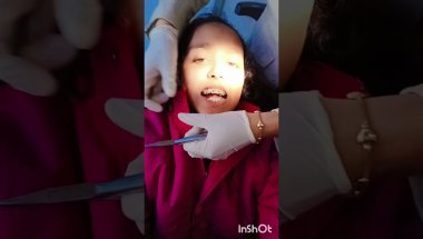 How Doctor tighten Sixth Month braces