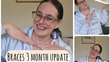 3 MONTH BRACES UPDATE 🤓