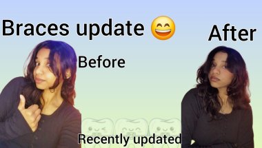 😔Recently updated ll braces update before and after part 1 #braces#bracesupdate#viral#bracesvlog