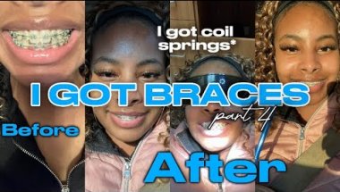 I GOT BRACES!! Part 4 | retighten & coil springs* | Brya Life