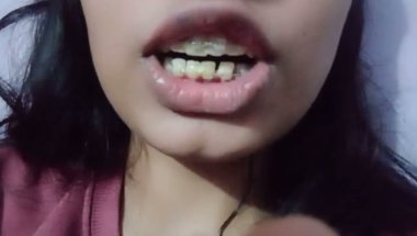 My  braces appointment (🥰🥰☺🥳#braces #braces transportation #love  #orthodontics #duet #youtubeindia