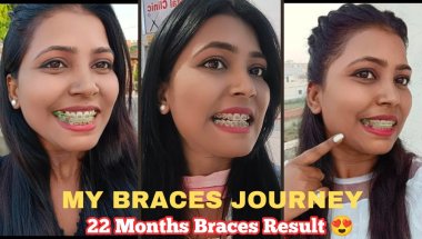 🦷😍 Braces & Facial Changes: My Lips, Chin - ( Myth vs Reality😨) #braces #bracesmyths #transformation