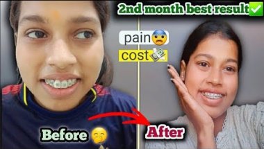 2nd month braces tightening best result 👌 ✅️🦷😬|| Painful journey😨#dentist #viral #vlog #subscribe...
