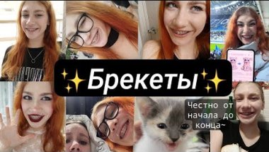 Брекеты: как это было