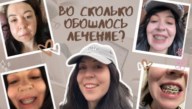 Брекеты: моя история и цена лечения