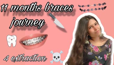 My 11 Months Braces journeyy |  Under 5K  |  4 Extractions  |   pain  |  fear