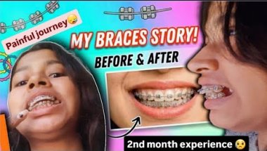 My Braces Story Before and After 2026😬🦷|| Painful Journey😪😥#dentist #vlog #viral #subscribe.....