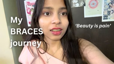My BRACES transformation journey | best decision of my life | pretty privilege
