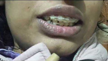 Braces vlog with me /🥰🧐#braces #love #smiledesigndental #orthodontics #duet #transformation