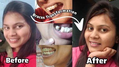 Braces Transformation: Before vs After (Unbelievable! 😱)"