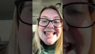 6 Week Adult Braces Update!