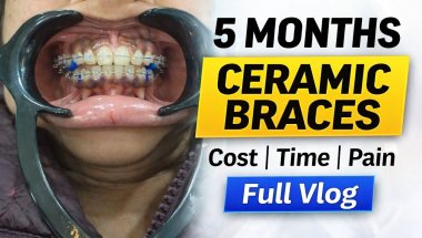 5 Months Ceramic Braces Journey | Cost, Pain & Time | Full Vlog