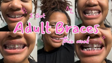 Adult Braces Transformation: Day 1 | New Smile Loading