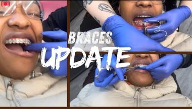 Braces Update: ONLY 2 MORE APPOINTMENTS UNTIL WE DEBRACE
