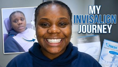 Getting Invisalign at 21 | What to Buy, What to Expect, What I Learned