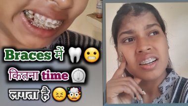 Braces me kitna time lagta hai🤯|| Braces kab removed hote hai💢| #dentist #viral #vlog #subscribe...