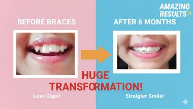 6 Months Braces Transformation | Before & After Results 🦷✨#orthodontics #bracestransformation