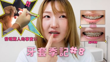 牙套季記 #8🦷 原來醫生沒換線⁉️看回放才解開我的千古謎團‼️🤣｜白 @xx.bb.ai