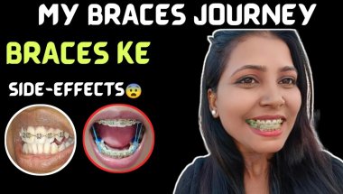 MY BRACES JOURNEY l Watch This Before Getting Braces l Braces ke Side-effects  Honest Story😨 #braces
