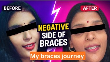 Negative side of braces😭|before vs after facial profile |my braces journey 😭