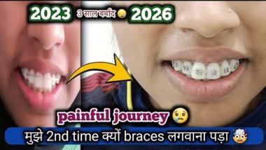 Second time getting braces 😬|| teen saal barbaad🤯|| Painful Journey😢#dentist #vlog #viral #subscribe