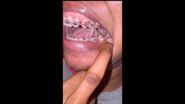 SECRETS NO ONE TELLS YOU ABOUT BRACES (part 1)