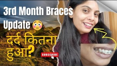 दर्द कितना हुआ? 😳 3rd Braces Adjustment Truth