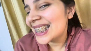 Mere braces ke wire nikal gye 🥲#trending #youtube #teeth #dentalcare #viral #dentist