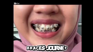 Braces journey 12 months #braces #bracesprogress