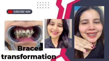 Braces lgane ke baad keisa feel hota hai🥲🦷#viral #trending #teeth #dentist #youtube #dentalcare