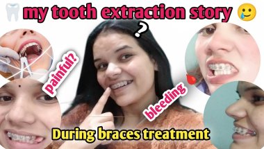 😰 story of tooth extractions during  Braces 🦷🩹❤️//5 दांत उखड़वाए🤢 watch this before treatment