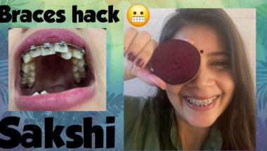 Braces ke saath celebrity jaisa glow sirf 7 dino me#trending #viral #youtube