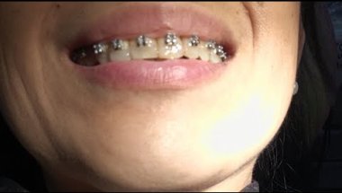 Oral Prophylaxis, Filling, Brackets & Braces Adjustment w/Elastic Attachment, & Myofascial Release