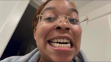 What Invisalign is really like | 6 week update
