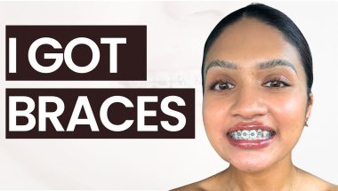 I Finally Got Braces… My Honest Day 1 Experience