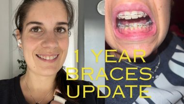 1 year update on my braces journey