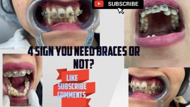 4Sign You Need Braces or Not#viral #trending #youtube #toptrending #teeth #smiledesigndental #short