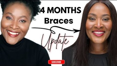 Adult Braces Journey: Why I Said No to Invisalign | 4 Month Update | Detutu
